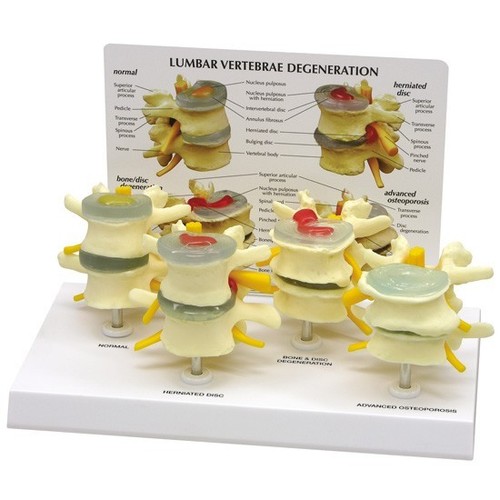 Vertebre lombari osteoporosi - lombari,