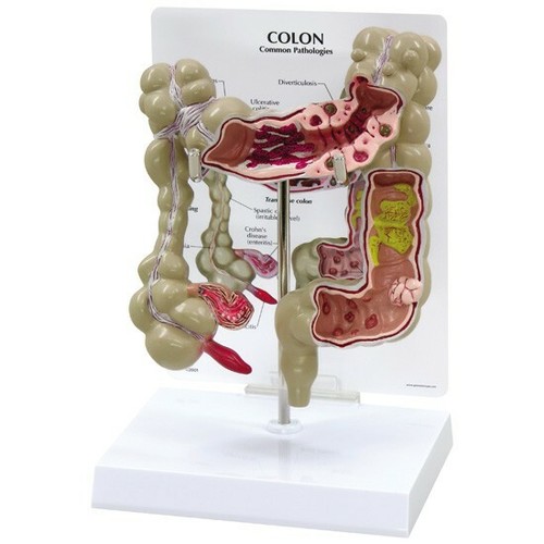 Modello anatomico malattia del